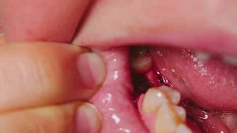 Close-up of a bloody socket after a tooth extraction Stock Footage 346472179