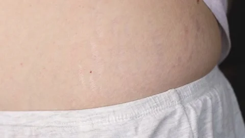 Close-up of the body with stretch marks and scars, loss of elasticity. Stock Footage 180905823