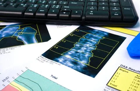 Close up Bone Densitometry Result on the table in room doctor. Stock Photos