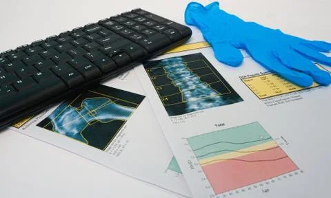 Close up Bone Densitometry Result on the table in room doctor.Healthcare and  Stock Photos
