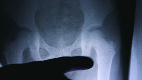 Close up bone x-ray medical science background Stockbeeldmateriaal 146280629