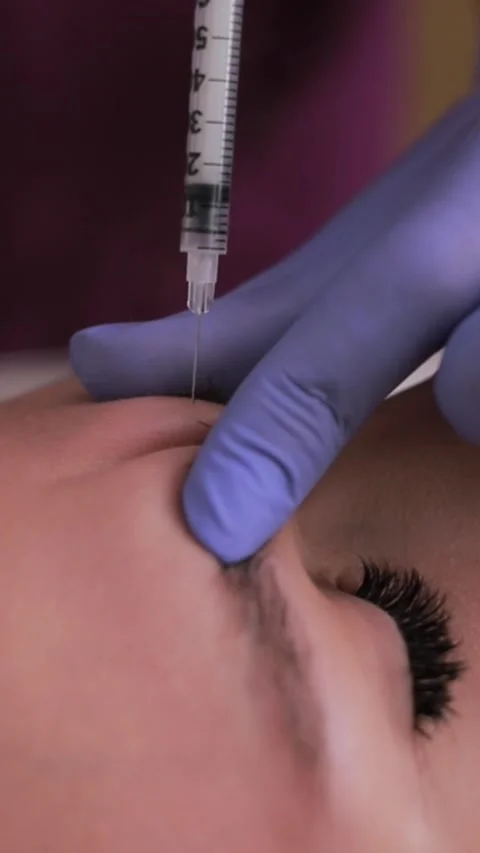 Close-up of the Botox injection process in the area between the eyebrows Stock Footage 308429073