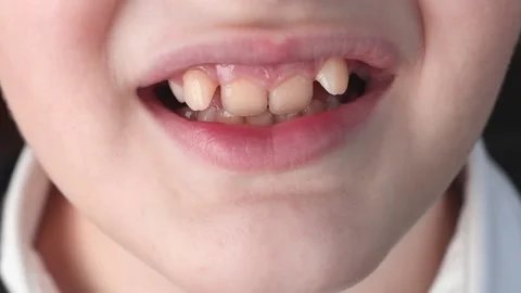 Close-up of a boy's face with improperly growing teeth. Stock Footage 170476457
