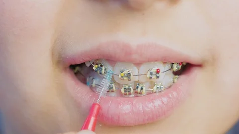 Close-up braces on the girl's teeth Stock Footage 103854587