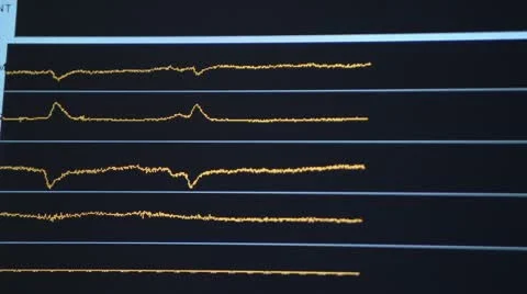 Close on brain waves on monitor Stock Footage