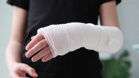 Close-up of a broken arm of a child in a cast. Stock Footage 173436124