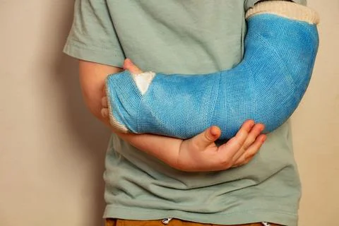 Close-up of a broken hand blue plaster cast after accident Stock Photos