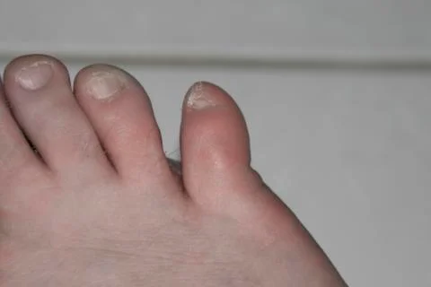 A close up of a broken toe Stock Photos
