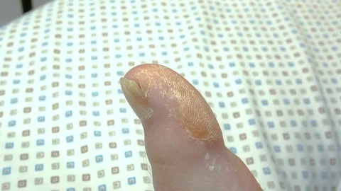 Close-up of a brown callus on a big toe with a fungus in a nail Stock-Footage 87738591