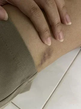 Close-up of Bruise on Thigh Foto stock