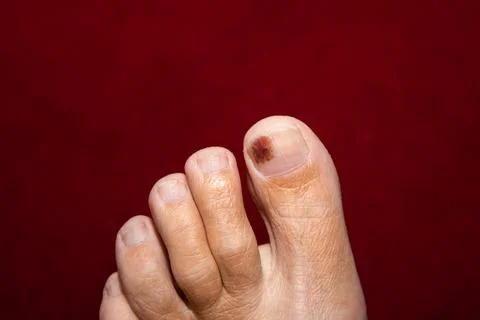 Close-up of a bruised big toe with visible subungual bruising Stock Photos