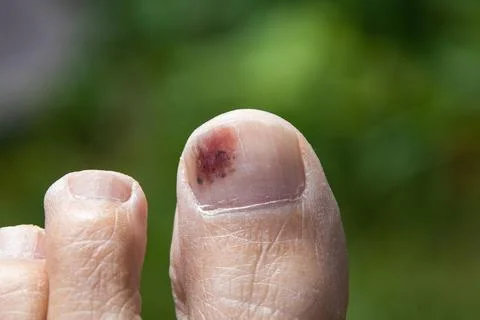 Close-up of a bruised big toe with visible subungual bruising Stock Photos