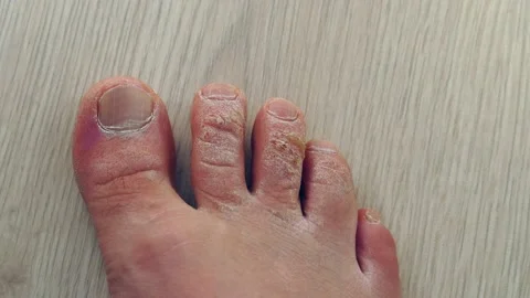 Close-up callus formation on the toes of a man, dead skin on the fingers, Stock Footage 171072645