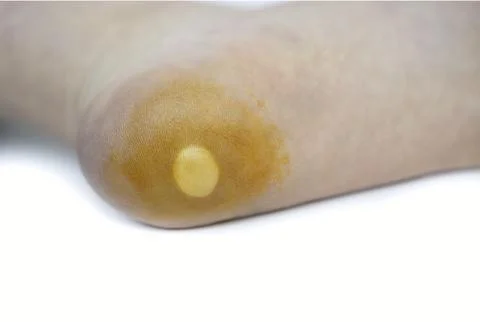 Close-Up of a Callus or Corn on a Human Heel 写真素材