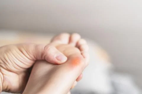 Close up of calluses. Problem skin on the steps of a teenager Stock Photos