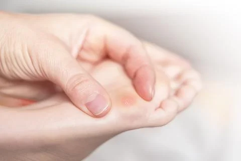 Close up of calluses. Problem skin on the steps of a teenager Stock Photos