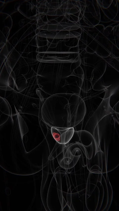 Close up of cancer in prostate area in Vertical X-Ray Video | Prostate Cancer Stock Footage 301877863
