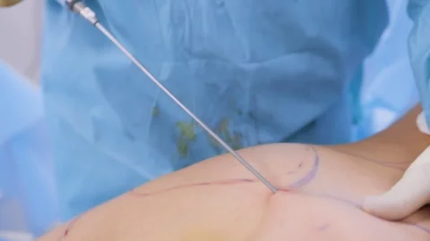 Close-Up of Cannula Inserted for Liposuction Procedure on Marked Skin in Cli 動画素材 308419875