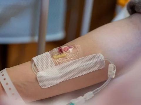 Close up of a canula inserted into a patient's arm Stock Photos
