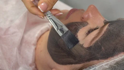 Close-up carbon face peeling procedure. Laser pulses clean skin of the face Stock Footage 129531668