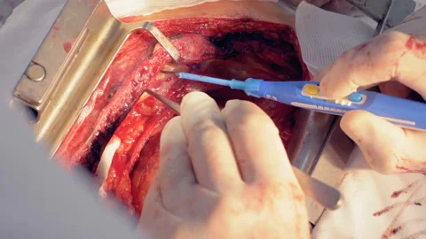 Close up of a cardiovascular surgery process Stock Footage 88543375