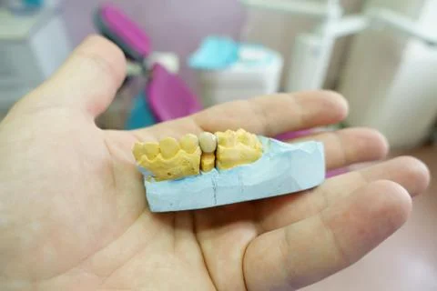 Close-up ceramic tooth crown on a plaster model of teeth in the dentist's han Stock Photos