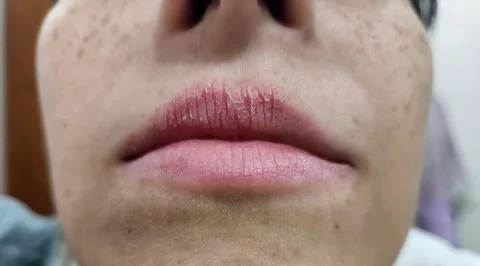 Close-up of Chapped Lips Stock Photos