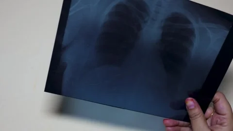 Close Up Of Chest X Ray Image Held By Hand During Medical Health Assessment Stock Footage 342785480