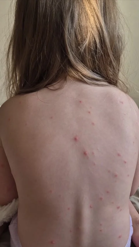 Close-up of chickenpox rash on a child's back Stock Footage 297102797