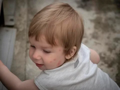 Close-up of a child with a bitten face Stock Photos