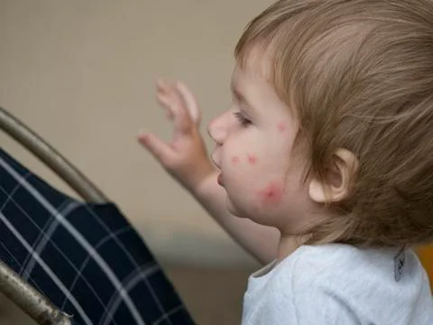 Close-up of a child with a bitten face Foto stock
