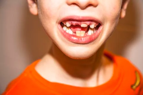 Close-up of child of eight years with the problem of not loosing his baby teeth Stock Photos
