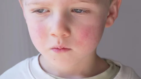 Close up of child with red cheeks and rash showing allergy, atopic dermatitis Stock-Footage 330973142