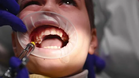 Close-up child with a retractor in mouth, getting a dental anesthesia injection Stock Footage 229983209