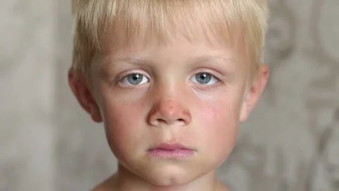 Close-up of a child's face with sunburn on the face and nose. Sun burn. Stock Footage 117101689