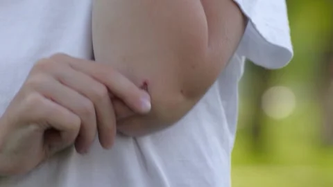 A close-up of a child's hand picking a sore on the elbow on a blurred green Stock Footage 163226950