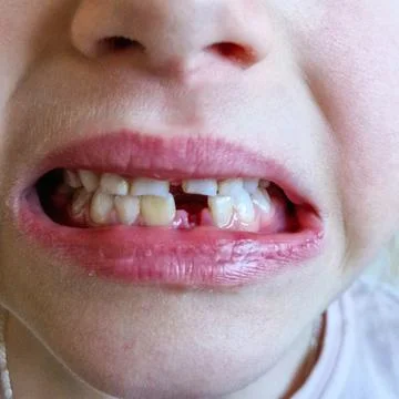 Close-up of a Child's Missing Tooth Stock Photos