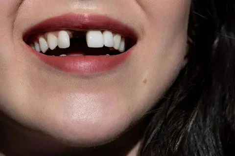 Close-up of a child's smiling face with missing teeth Stock-Fotos
