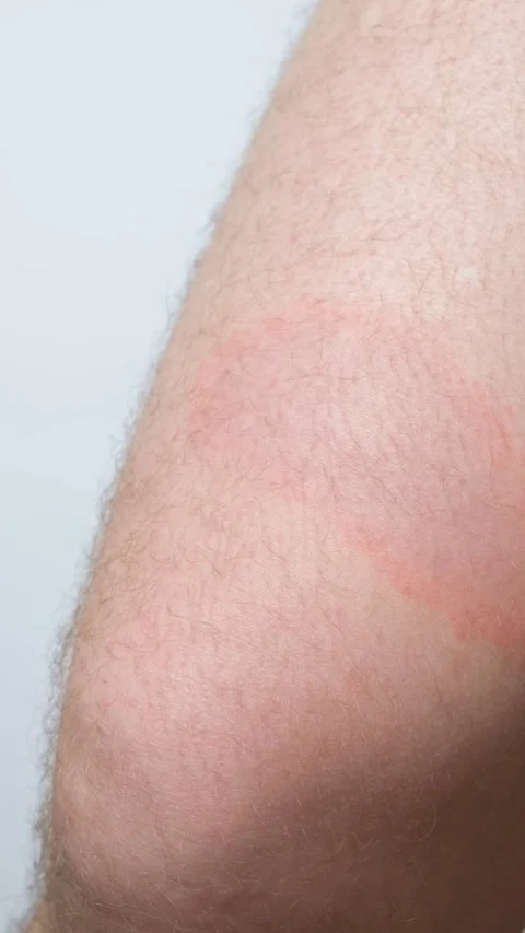 Close-up of circular red skin lesion characteristic of Borreliosis infection aft 库存影片 344038427