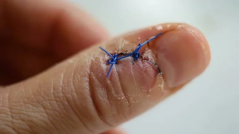 Close-up of clear liquid dripping on dry skin and stitches on the wound, on the Stock Footage 143749160