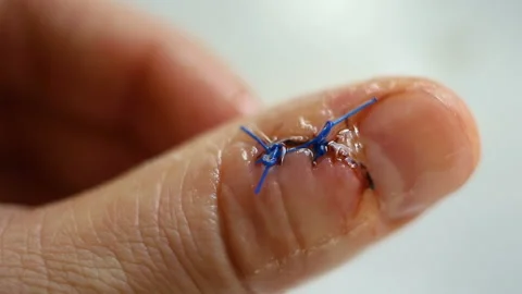 Close-up of a clear liquid dripping on a person's injured finger.  Contains peop Stock Footage 143749183