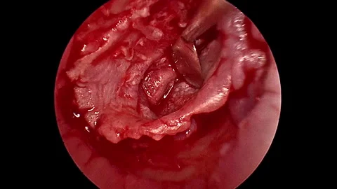 Close-up clinical endoscopic view of an ear operation performed by a... Vidéo 342729042