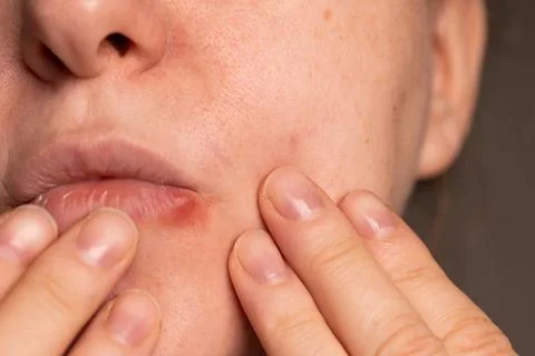 Close-up of Cold Sore Outbreak on the Lip of an Adult Stock Photos