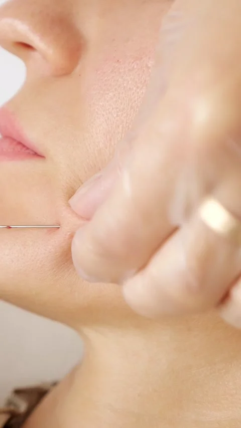 Close up of collagen pdo thread lift procedure for skin rejuvenation, anti aging Stockbeeldmateriaal 341446967