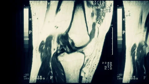 Close up of a computed tomography scan of an injured knee. Frame by frame. 動画素材 145363550