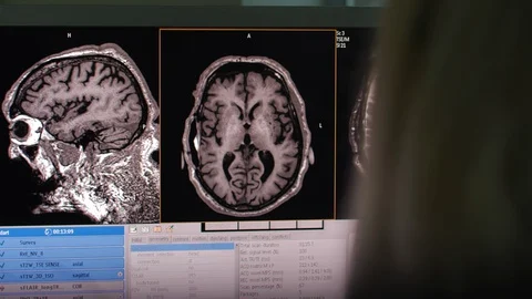 Close-up of computer monitor, interactive tomogram of human brain, doctor Stock Footage 128283823