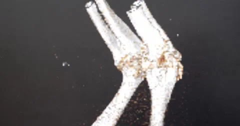 Close-up on a computer screen showing the results of a CT scan of a dog's knee Stock Footage 225767061