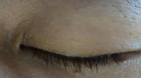 Close up conjunctivitis on eyes Stock Footage 37517562