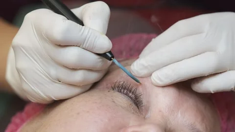Close-up of a cosmetic electrocoagulation procedure on a womans eyelid in a.. Vídeo Stock 331254312