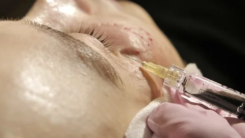 Close-up of the cosmetologist doing botulinum toxin injections for the client in Stock Footage 124301151